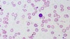 Health experts say ‘harmless’ symptoms could be signs of blood disease